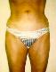 Liposuction Picture
