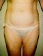 Liposuction Picture