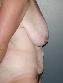 Tummy Tuck Picture