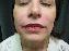 Injectable Fillers Picture
