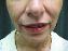 Injectable Fillers Picture