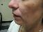 Injectable Fillers Picture