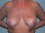Breast Reduction Picture