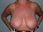 Breast Reduction Picture