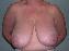 Breast Reduction Picture