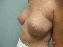 Breast Reconstruction Picture
