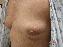 Breast Reconstruction Picture
