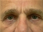 Eyelid Surgery Picture