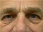 Eyelid Surgery Picture