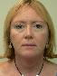 Facelift Picture