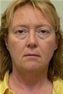 Facelift Picture