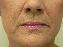 Injectable Fillers Picture