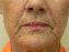 Injectable Fillers Picture