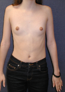 Pittsburgh Breast Augmentation Cost