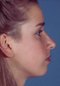 Cost of Pittsburgh Rhinoplasty