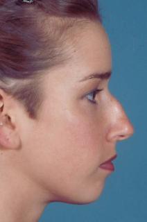 Pittsburgh Rhinoplasty Pricing