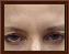 Botulinum Toxin Picture