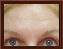 Botulinum Toxin Picture