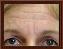 Botulinum Toxin Picture