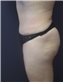 Tummy Tuck Picture