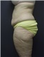 Tummy Tuck Picture