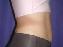 Liposuction Picture