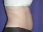 Liposuction Picture