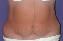 Body Contouring After Major Weight Loss Picture