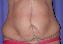 Body Contouring After Major Weight Loss Picture