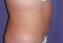 Body Contouring After Major Weight Loss Picture
