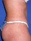 Tummy Tuck Picture