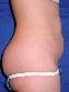 Tummy Tuck Picture