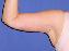 Arm Lift Picture