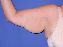 Arm Lift Picture
