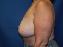 Breast Reduction Picture