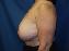 Breast Reduction Picture