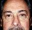 Eyelid Surgery Picture