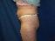 Tummy Tuck Picture