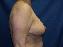 Breast Reduction Picture