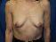 Breast Augmentation Picture