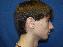 Ear Surgery Picture