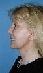 Facelift Picture