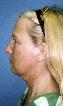 Facelift Picture