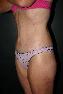 Body Contouring After Major Weight Loss Picture