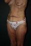Body Contouring After Major Weight Loss Picture