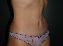 Tummy Tuck Picture