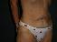 Tummy Tuck Picture