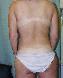 Body Contouring After Major Weight Loss Picture
