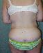 Body Contouring After Major Weight Loss Picture