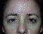 Eyelid Surgery Picture